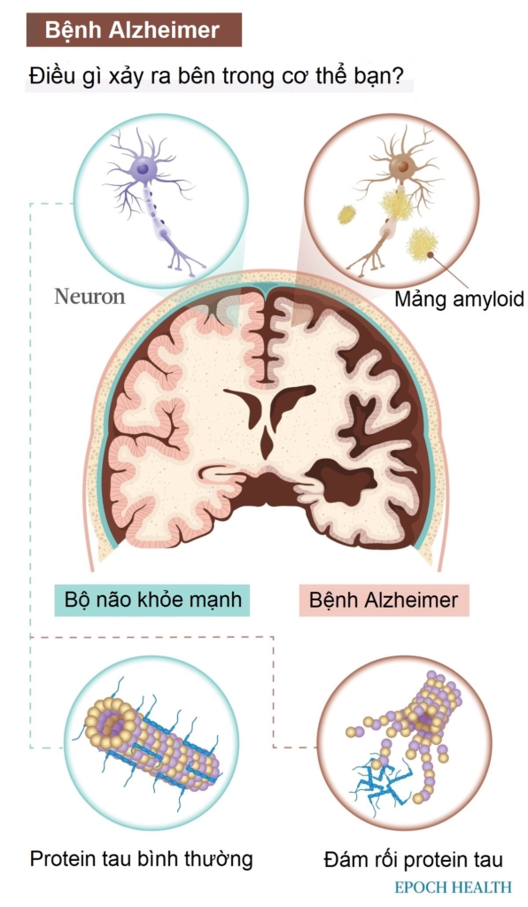 Hướng dẫn cơ bản về bệnh Alzheimer: Triệu chứng, nguyên nhân, điều trị, và giải pháp tự nhiên