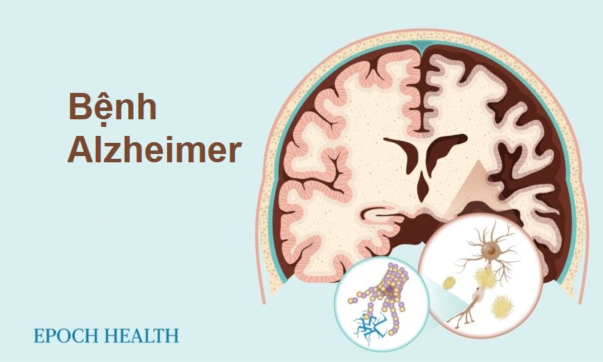 Hướng dẫn cơ bản về bệnh Alzheimer: Triệu chứng, nguyên nhân, điều trị, và giải pháp tự nhiên