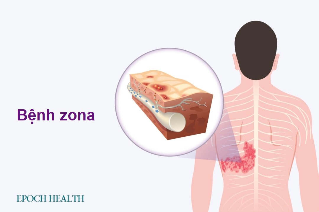 Hướng dẫn cơ bản về bệnh Zona (Herpes Zoster): Triệu chứng, nguyên nhân, điều trị và các cách tiếp cận tự nhiên