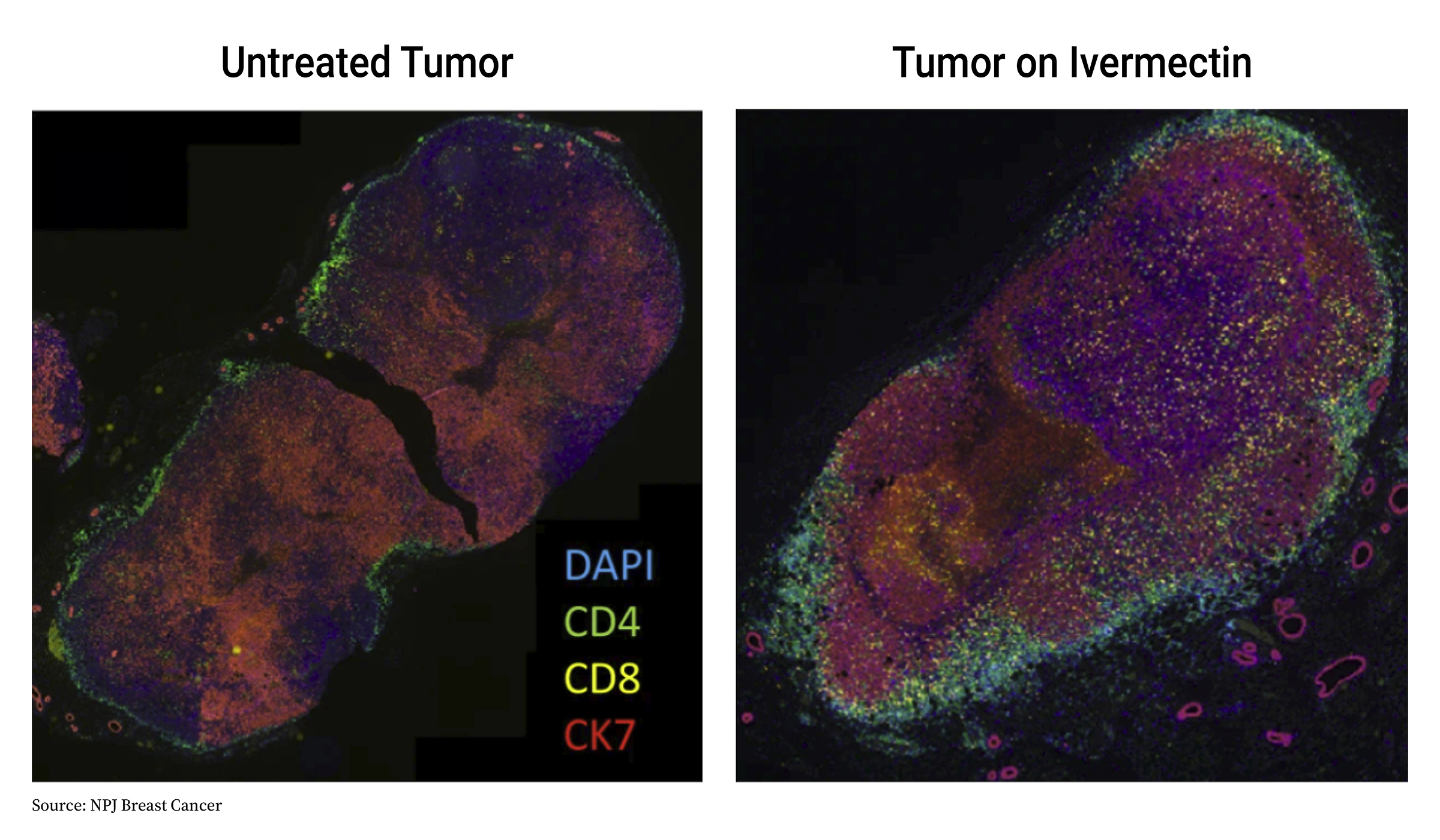 Tế bào miễn dịch CD4+ (xanh lá cây), tế bào T CD8+ (vàng) và tế bào ung thư (đỏ) được thể hiện qua nhuộm màu. (Được sự cho phép của NPJ Breast Cancer)
